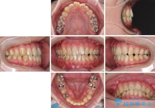 欠損のある歯列　インビザラインで整った歯並びにの治療前