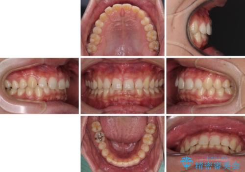 深い咬み合わせと隙間の空いた歯列をワイヤー矯正で改善の治療前