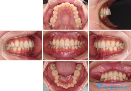 【モニター】インビザラインをしっかり使って短期間矯正治療の治療前