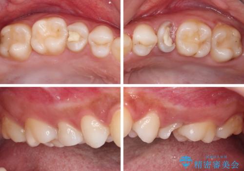 抜歯と言われた歯を残したい 部分矯正と外科処置を用いた補綴治療の治療前