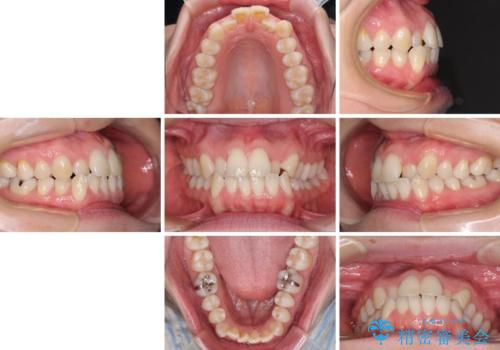 受け口傾向の歯並びをインビザラインで改善の治療前