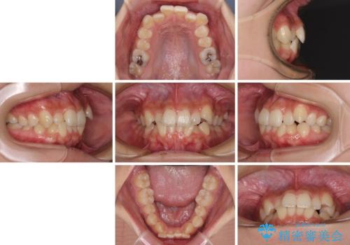 デコボコと八重歯の目立つ前歯 ワイヤー装置による抜歯矯正の治療前