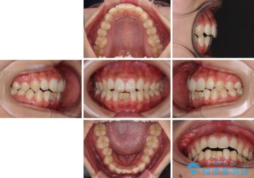 乳歯残存と欠損の前歯　矯正治療とオールセラミックブリッジ治療の治療前