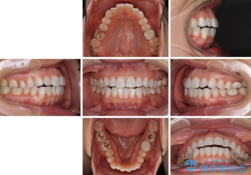 ちょっとしたデコボコをしっかりと改善したい インビザライン矯正の治療前