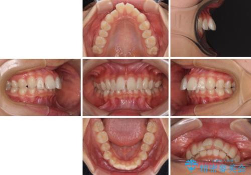深い咬み合わせで前方に煽られた前歯 高校生のインビザライン矯正治療の治療前