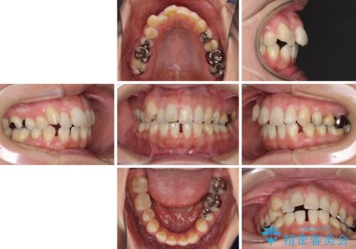 閉じにく口元と欠損歯列 ワイヤー装置の抜歯矯正の治療前