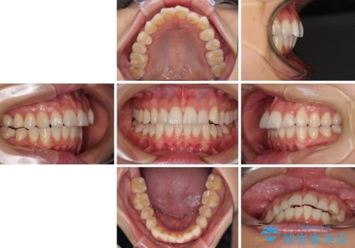 前にずれた咬み合わせをワイヤー装置でしっかりと改善の治療前