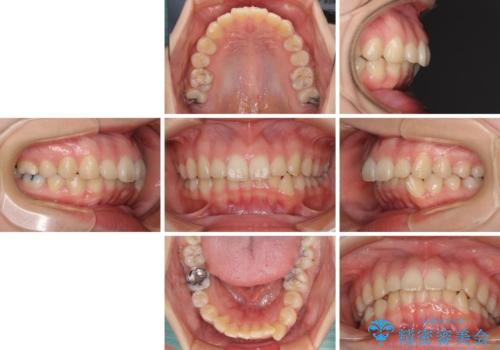 目立たない装置で出っ歯を治したい ハーフリンガル矯正の治療前