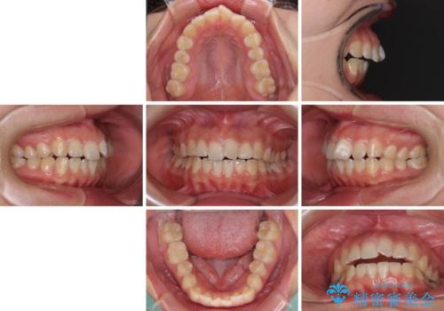 【モニター】カリエールディスタライザーとインビザラインを用いた奥歯の咬み合わせ改善の治療前