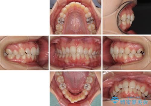 抜歯矯正の後戻り インビザライン・ライトによる矯正治療の治療前