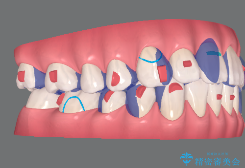 前歯のねじれを改善 マウスピース矯正インビザライン