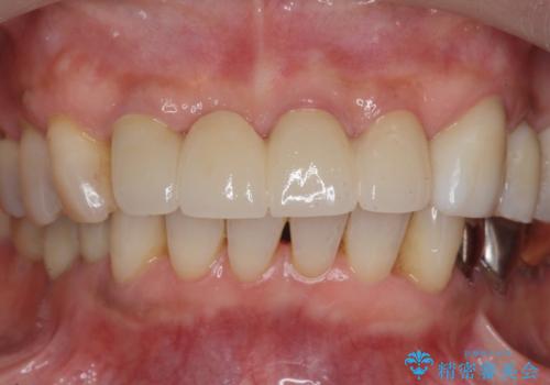 ぐらつく前歯 ブリッジ治療の治療後