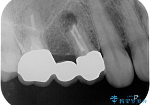 【歯根端切除術】根っこの治療をしたが、また腫れてきた。の治療中