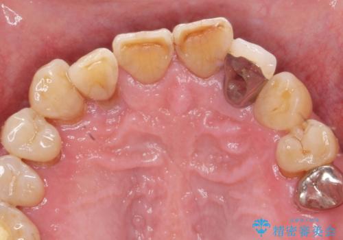 歯周病治療を伴う前歯審美セラミック治療の治療前