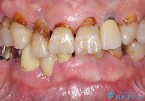 歯周病治療を伴う前歯審美セラミック治療の治療前