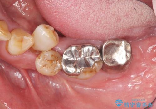 [ 歯周病治療 ] 小矯正を含むインプラント補綴・歯周補綴の治療前