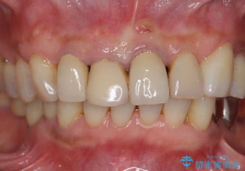 ぐらつく前歯 ブリッジ治療の治療前