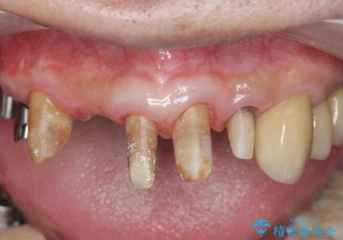 歯周病治療を伴う前歯審美セラミック治療の治療中