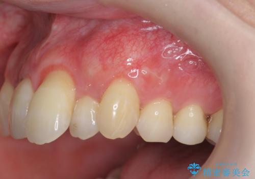 目立つ八重歯の歯ぐきのさがり  根面被覆による改善の症例 治療後