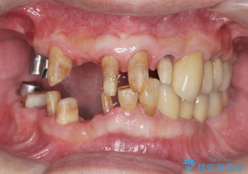 歯周病治療を伴う前歯審美セラミック治療の治療中