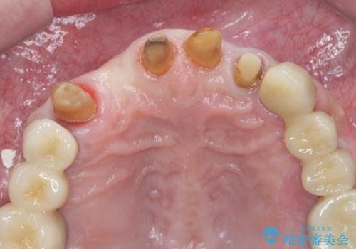 歯周病治療を伴う前歯審美セラミック治療の治療中