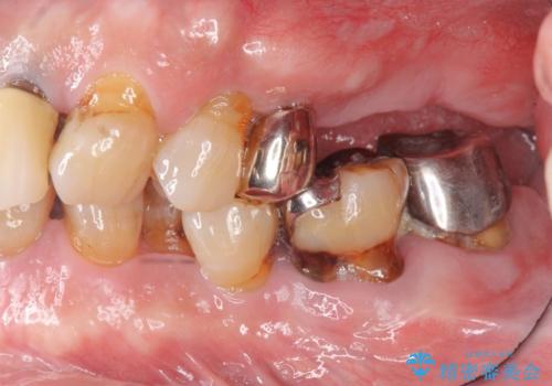 [ 歯周病治療 ] 小矯正を含むインプラント補綴・歯周補綴の症例 治療前