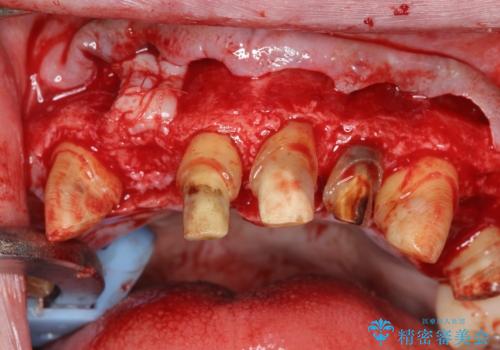 歯周病治療を伴う前歯審美セラミック治療の治療中