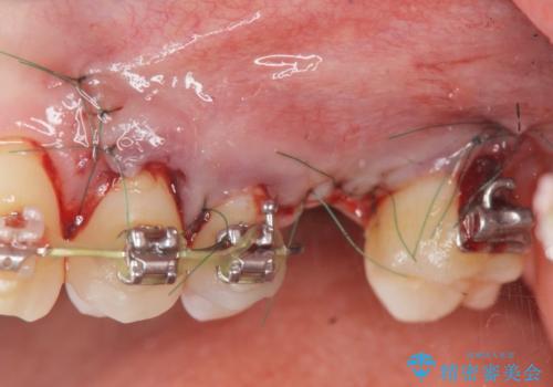 他院での矯正治療中 ソケットリフトを伴うインプラント治療依頼の治療中