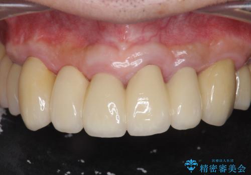歯周病治療を伴う前歯審美セラミック治療の症例 治療後