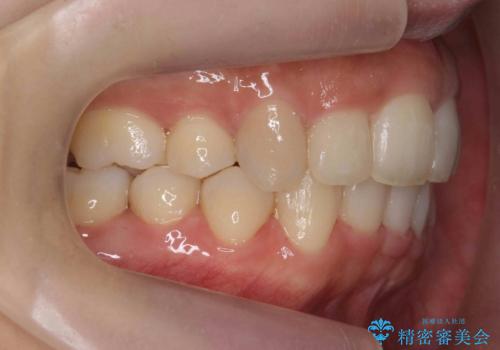 前歯がでている　最小限の抜歯で口を閉じやすくの症例 治療後