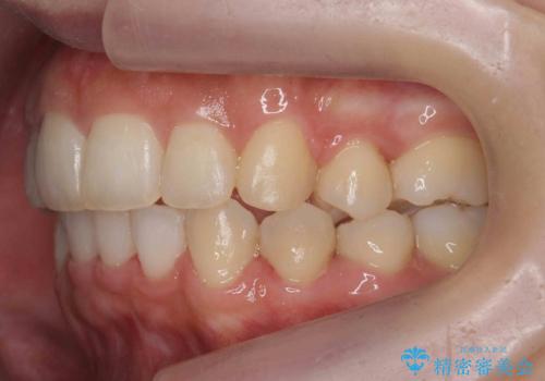 前歯がでている　最小限の抜歯で口を閉じやすくの治療後