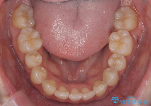 前歯がでている　最小限の抜歯で口を閉じやすくの治療後