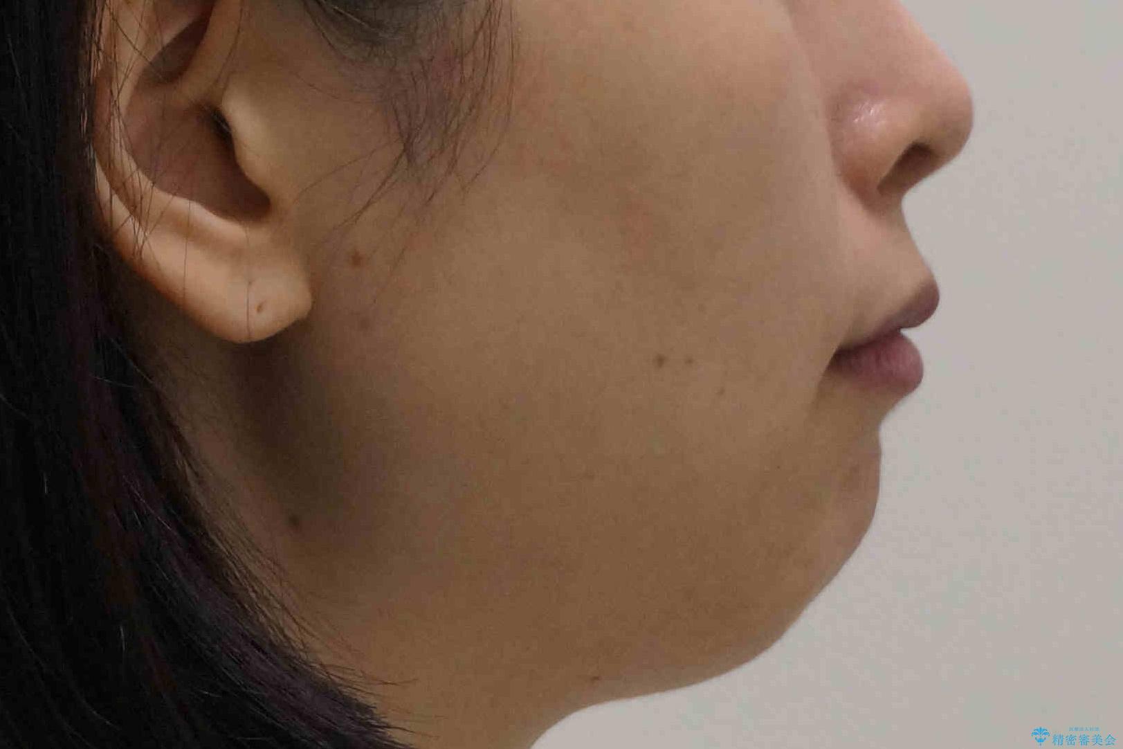 前歯がでている 最小限の抜歯で口を閉じやすくの治療後(顔貌)