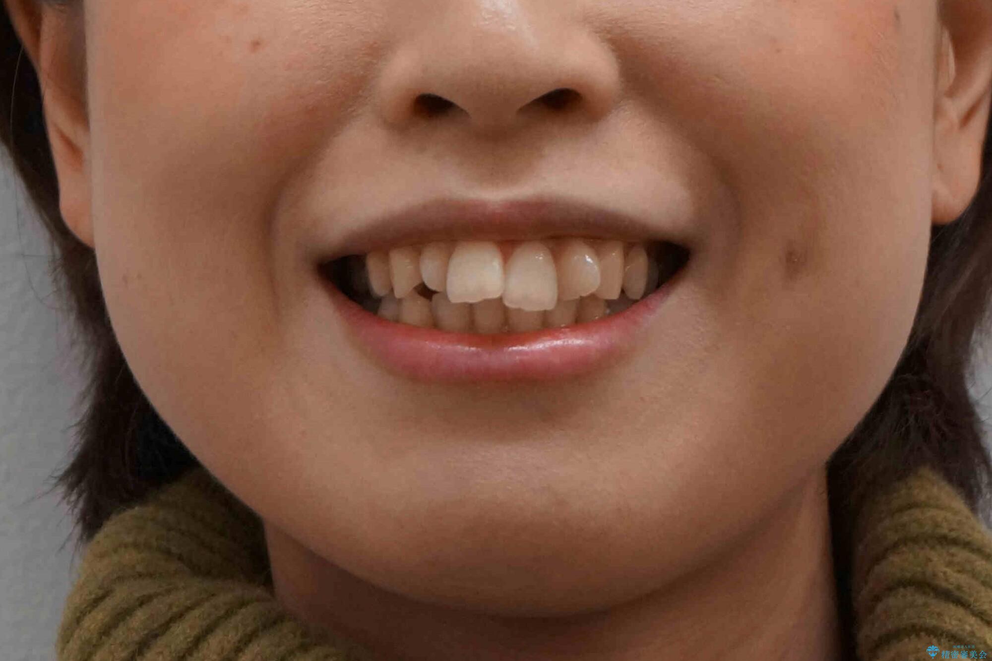 前歯がでている　最小限の抜歯で口を閉じやすくの治療前（顔貌）