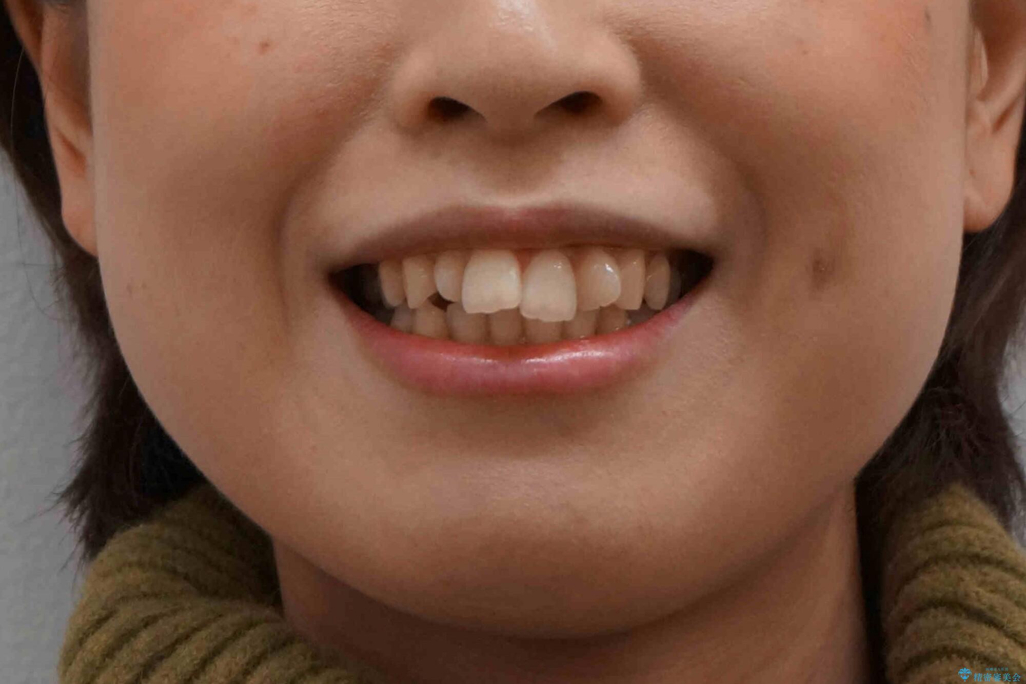 前歯がでている 最小限の抜歯で口を閉じやすくの治療前(顔貌)