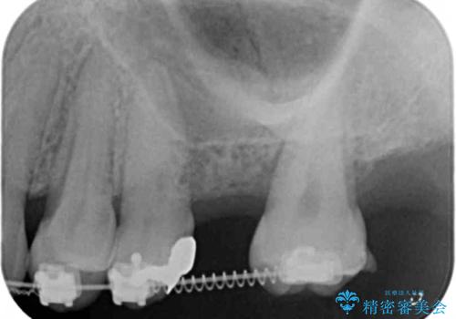 他院での矯正治療中 ソケットリフトを伴うインプラント治療依頼の治療前