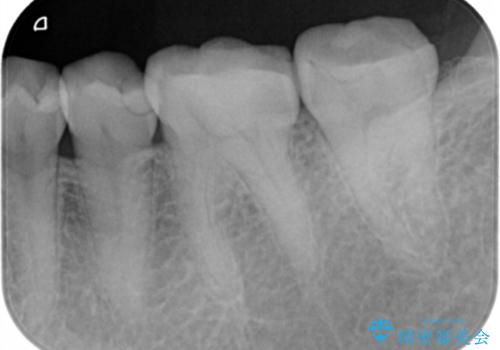 歯が黒くて虫歯じゃないかと心配して来院の治療前