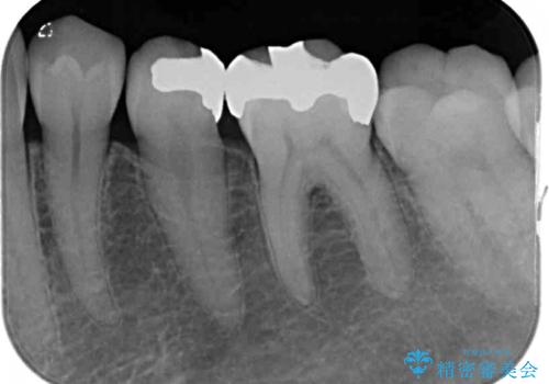 銀歯をセラミックにしたい セラミックインレー修復の治療前