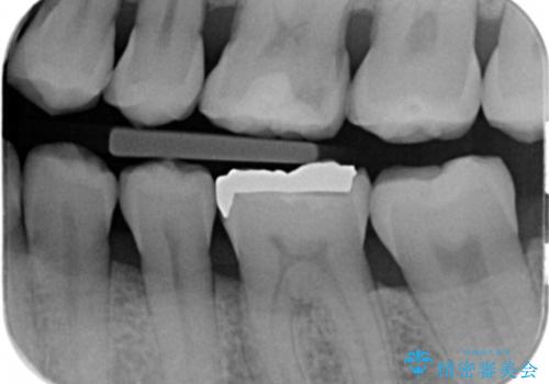 検診で虫歯を発見。の治療前