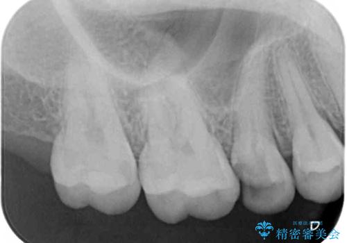 抜歯と言われた歯を残したい 部分矯正と外科処置を用いた補綴治療の治療前