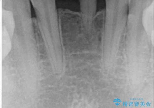 乳歯残存と欠損の前歯 矯正治療とオールセラミックブリッジ治療の治療前