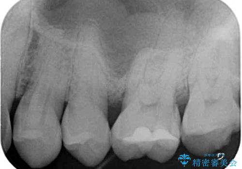 食事で割れてしまった奥歯 外科処置を用いた補綴治療の治療前