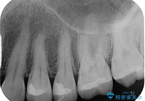 銀歯をセラミックにしたい セラミックインレー修復の治療後