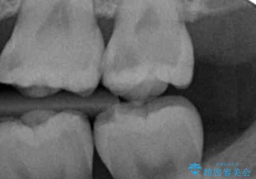 奥歯の放置した虫歯 セラミックでの治療の治療前