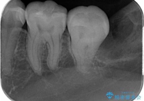 e-maxインレーによる治療の治療後