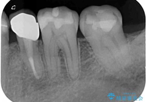 痛みの続く大きな虫歯の奥歯 オールセラミッククラウンでの補綴治療の治療前