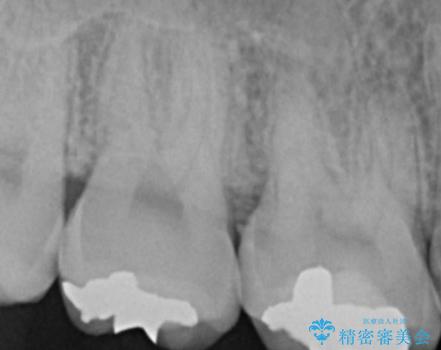 縁下歯石のクリーニングの治療前
