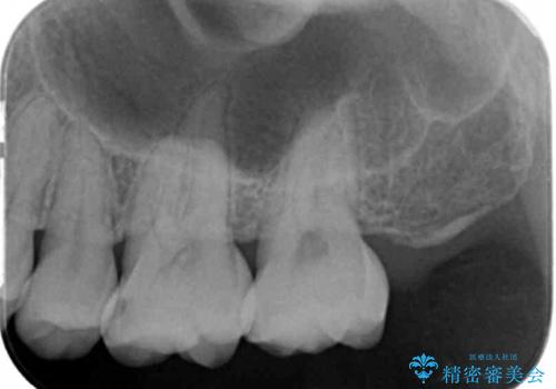 虫歯の発生を初期段階で発見 ゴールドインレー修復の治療前