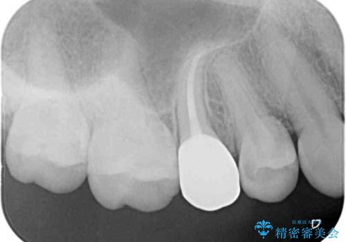 抜歯と言われた歯を残したい 部分矯正と外科処置を用いた補綴治療の治療後