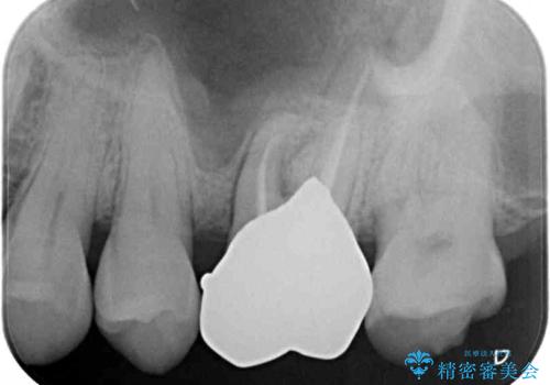 食事で割れてしまった奥歯 外科処置を用いた補綴治療の治療後